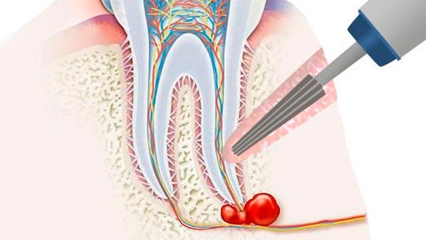 Методы удаления кисты зуба