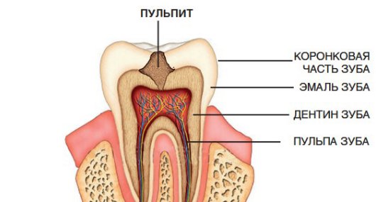 Пульпит - воспаление пульпы, соединительной ткани внутри зуба