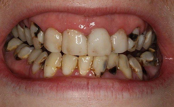 Пришеечный кариес на верхних зубах