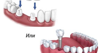 Непростой выбор: коронка или имплант?