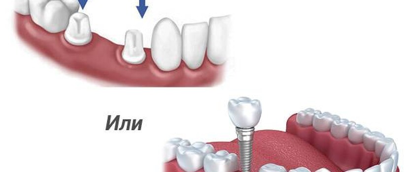 Непростой выбор: коронка или имплант?