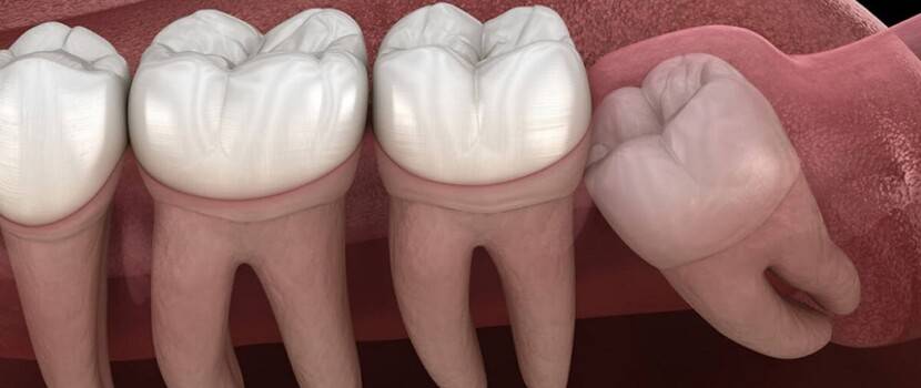 Особенности лечения пульпита зуба мудрости