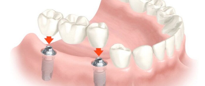 Мостовидные зубные протезы