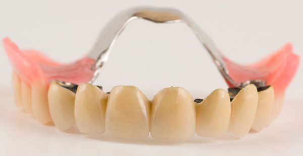 Бюгельный протез на передние зубы