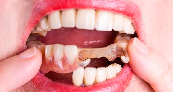 Фиксация мягкого зубного протеза