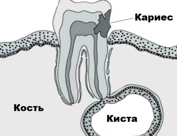 Цистоэктомия. Радикулярная киста зуба. Киста зуба причины возникновения.