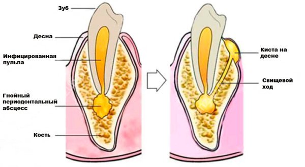 Осложнения кисты зуба