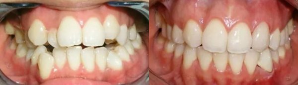 Зубы до и после лингвальных брекетов