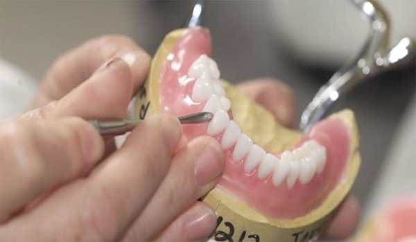 Установка зубного протеза