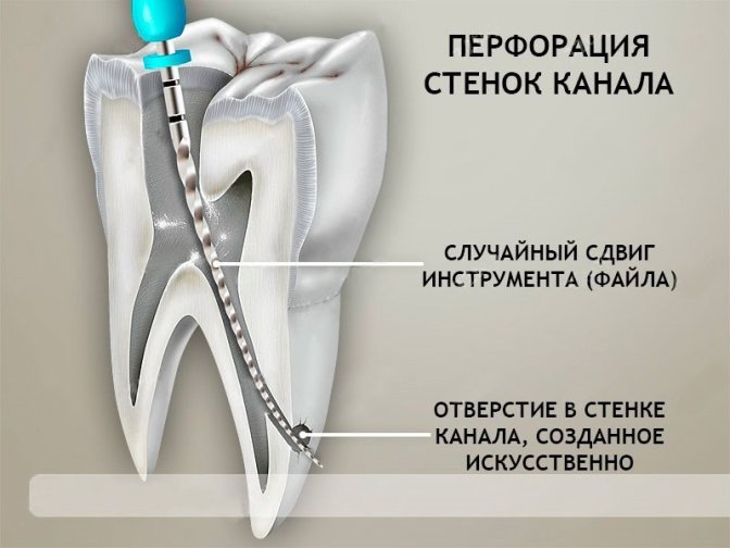 Боли в зубе при кусании могут возникнуть после депульпирования