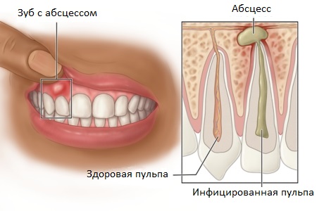 Как выглядит абсцесс зуба