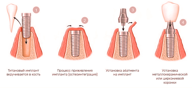 Этапы имплантации 