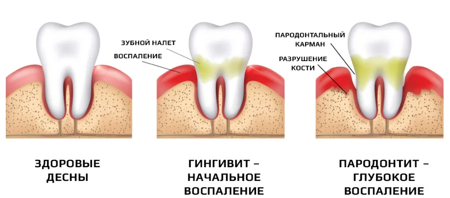 Стадии развития катарального гингивита: от здоровых к воспаленным