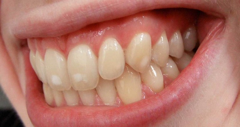 Как выглядит кариес на передних зубах в начальной стадии