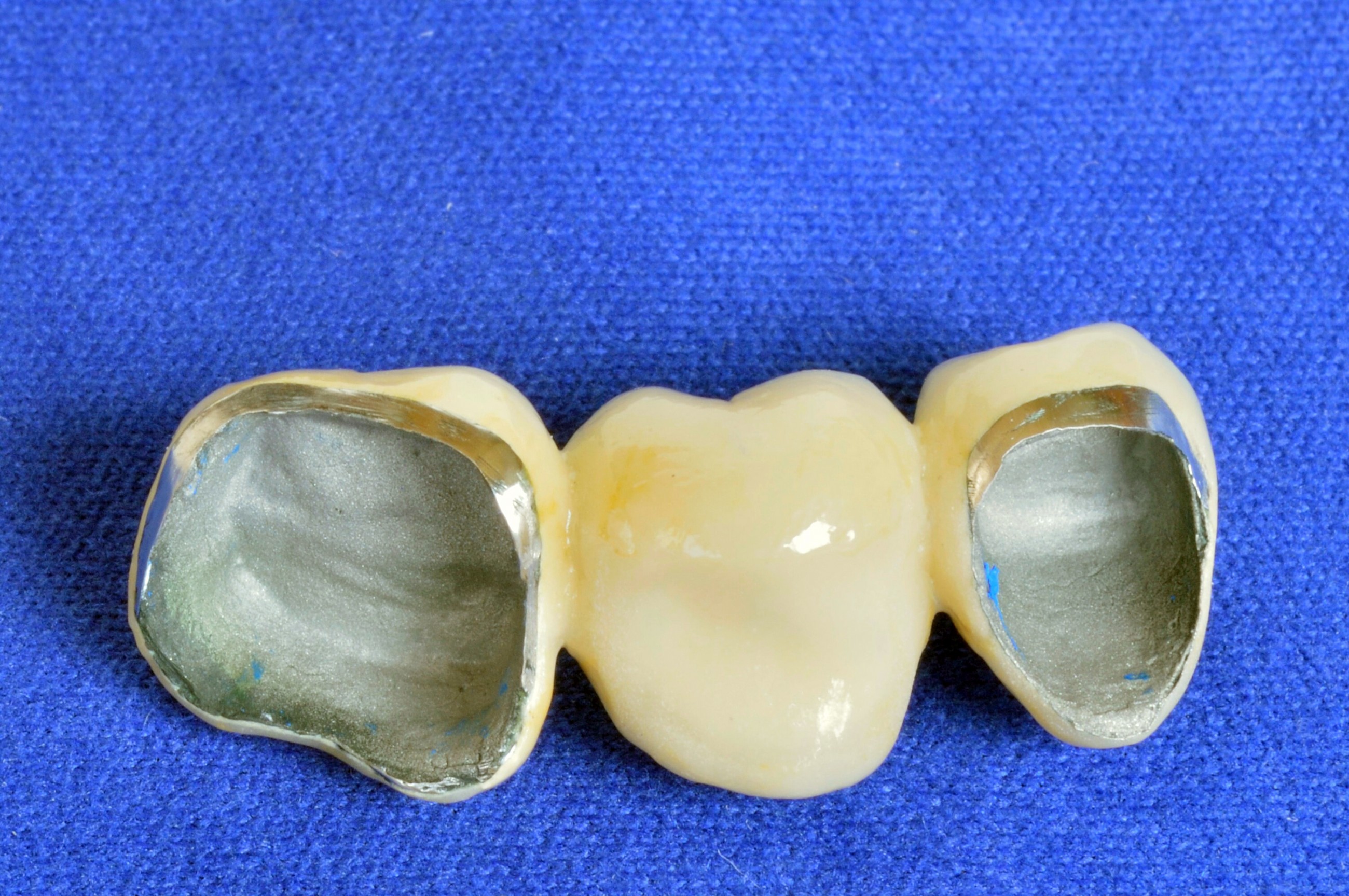 металлокерамические коронки на зубы
