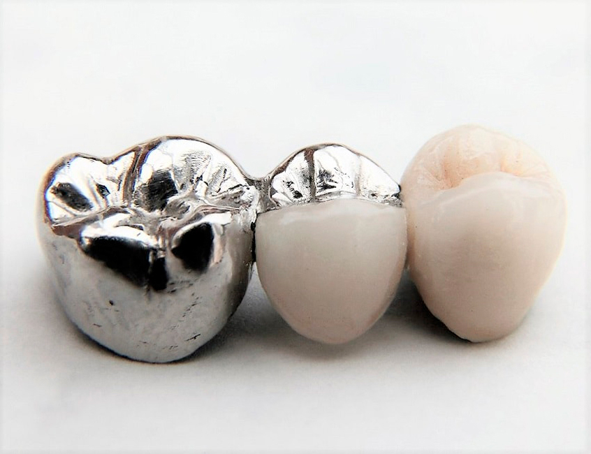 металлические корноки на зубы