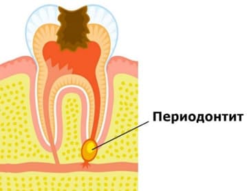 Острый апикальный процесс с формированием абсцесса