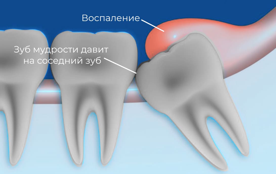 Механизм развития перикоронита