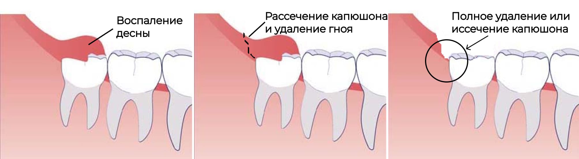 Иссечение капюшона при перикороните