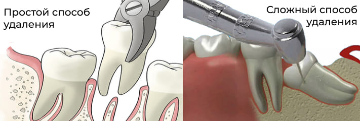 Простой и сложный способы удаления зуба мудрости