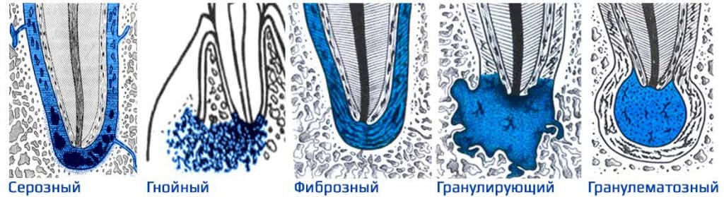 Виды периодонтита