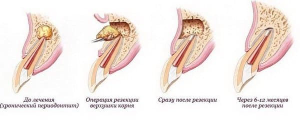 Этапы консервативной терапии апикального вида