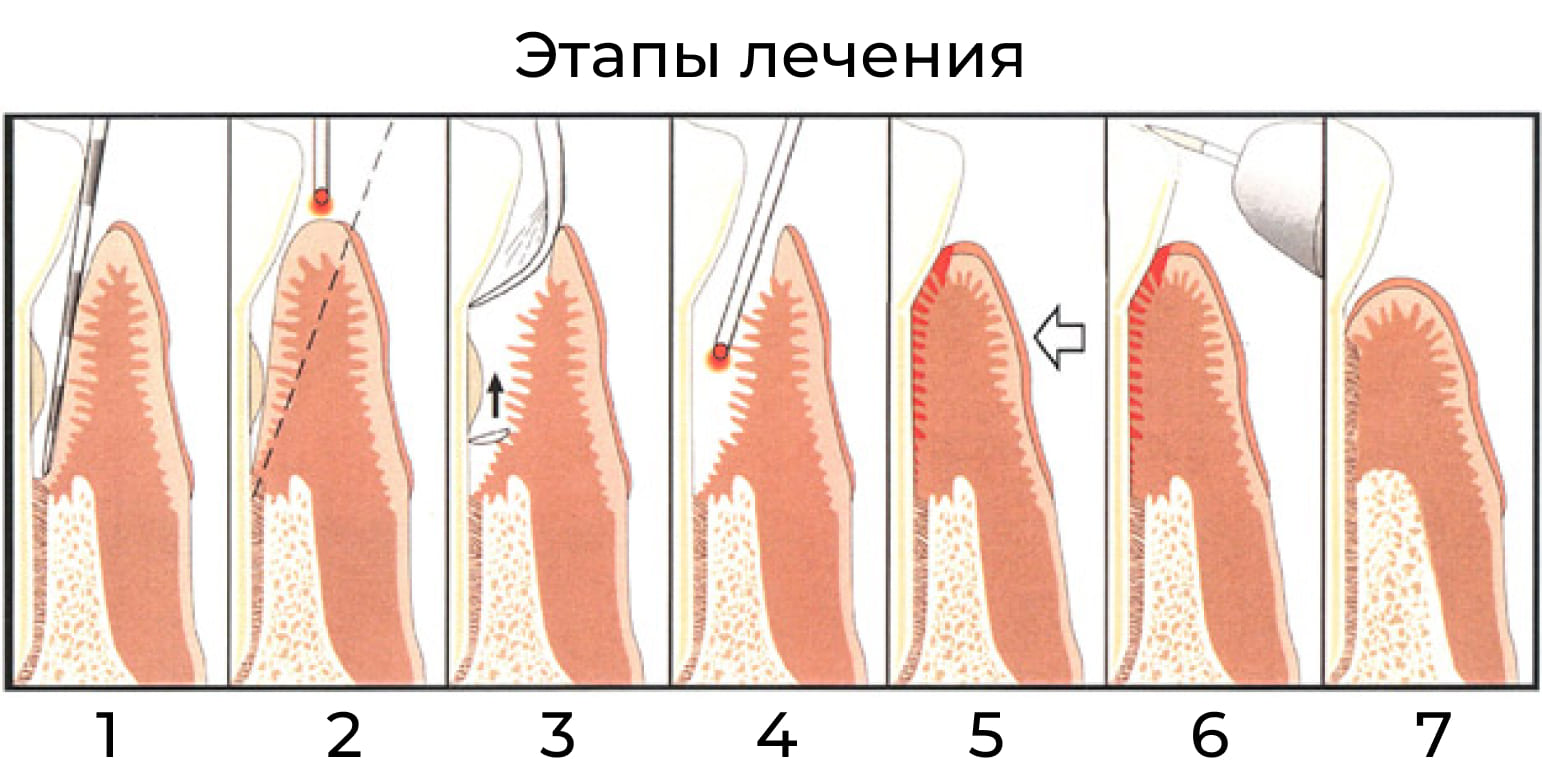 Этапы консервативной терапии апикального вида