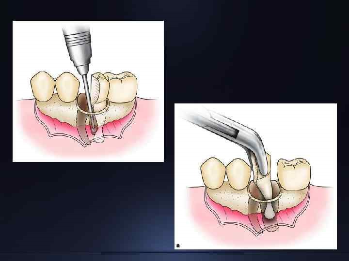 Бор и щипцы для сложного удаления зуба