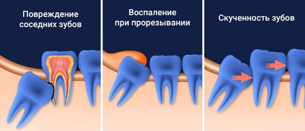 Осложнения при ретинированном зубе