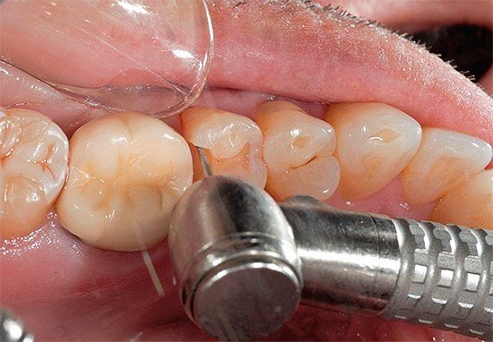 Препарирование зуба