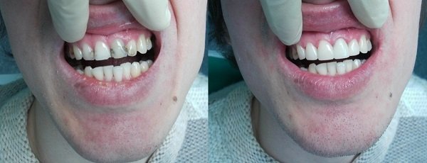 Кариес между передними зубами