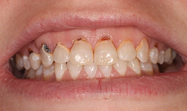 Кариес на разных частях зубов