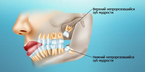 Повышение температуры после удаления зуба