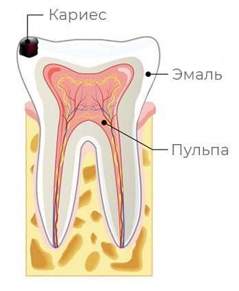 Поврехностный кариес зуба