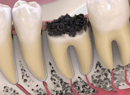 Показания к удалению корня зуба