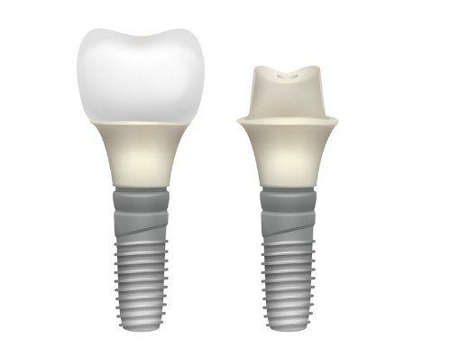 Разновидность имплантов для жевательных зубов