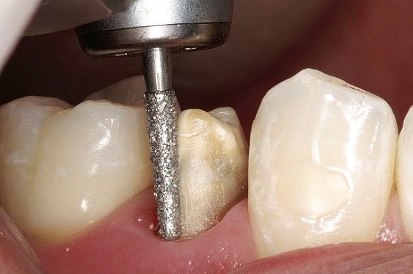 Процесс обточки зуба