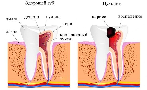 Пульпит – частая причина зубной боли при прикосновении