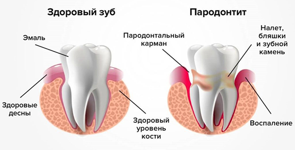 При воспалении десен болит зуб при нажатии на него