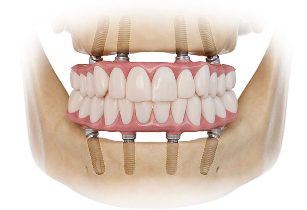 Условно-съемный акриловый зубной протез