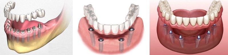 Методики имплантации зубов