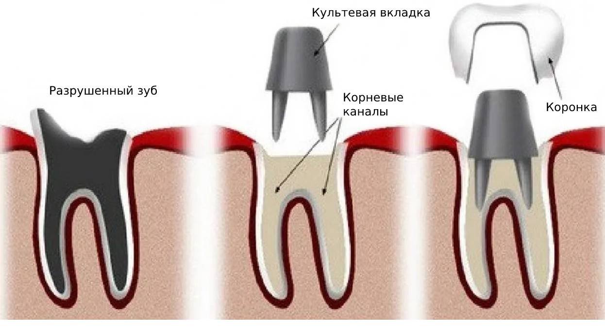 Культевая вкладка на зуб