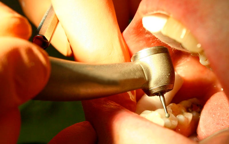 Препарирование кариозного зуба с помощью бормашины